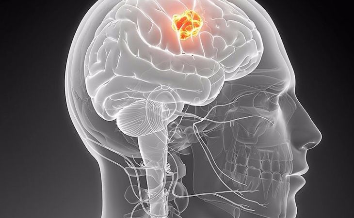 Учёные нашли средство от опухоли головного мозга