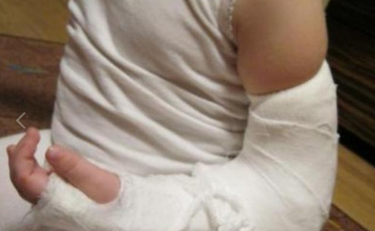 Ребёнок из алтайского села, которому в больнице наложила гипс "баба Валя", чуть не остался инвалидом
