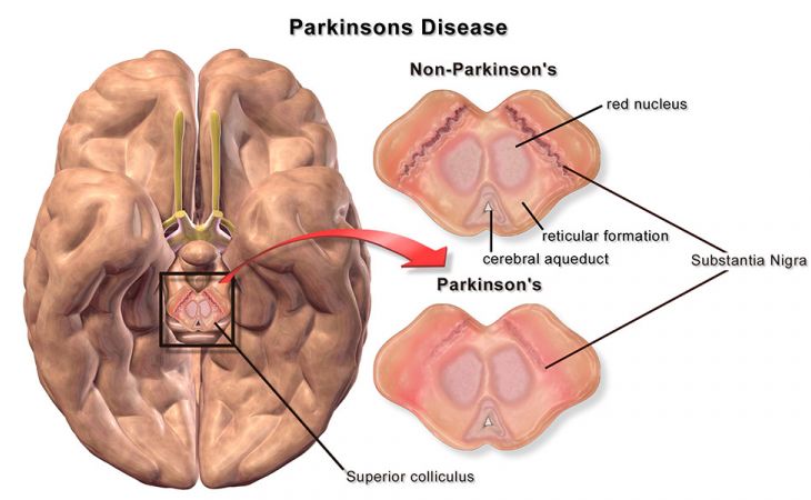 Российские ученые нашли средство от болезни Паркинсона