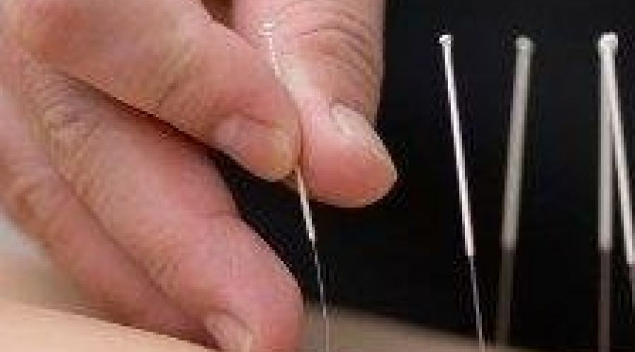Лечение иглоукалыванием становится популярным в Барнауле